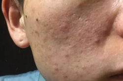 痤疮的治疗方法,综合疗法，告别青春痘困扰